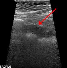 Appendicitis occurs due to inflammation of the appendix. Pediatric Appendicitis Symptoms And Surgery Online Medical Library