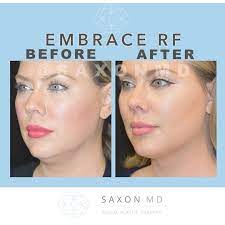 A special thanks to your staff susan and christine for all of their support as well. Before And After Of Embrace Rf Skin Tightening