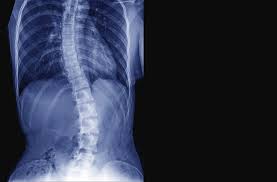 We did not find results for: How Scoliosis Can Lead To Breath Shortness