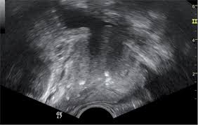 03.03.2010 · ultrasound is a widely used imaging modality for evaluation of the prostate. Scielo Brasil Ultrasound Detection Of Prostatic Calculi As A Parameter To Predict The Appearance Of Hematospermia After A Prostate Biopsy Ultrasound Detection Of Prostatic Calculi As A Parameter To Predict