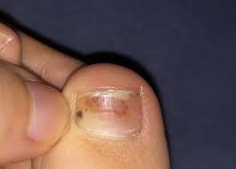 Schwarzer Hautkrebs Oder Nagelpilz Gesundheit Und Medizin Gesundheit Haut