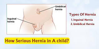 Image result for Inguinal hernia child