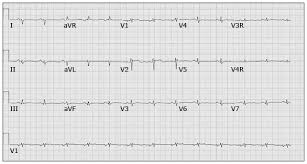 Myocarditis is an inflammatory disease of cardiac muscle that is caused by a variety of infectious and noninfectious conditions ( table 1)  1 . Ecg Of Myocarditis Uptodate