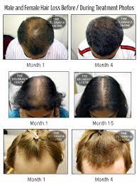 Hair loss from this form of alopecia is permanent, unfortunately, because once the follicles' stem cells and sebaceous glands are destroyed, the hair can't grow back. What Are The Different Types Of Alopecia