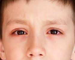 pink eye conjunctivitis causes