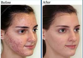 Acne Vulgaris Treatment How To Cure It Fast And Permanently Acne Vulgaris Blog