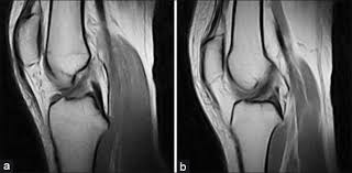 Grade 2 — noticeable looseness in the knee (the knee opens up about 5 millimeters) when moved by hand. Sagittal View Of The Knee Shows A Normal Anterior Cruciate Ligament Download Scientific Diagram