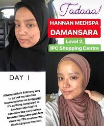 Hannan medispa, kuala lumpur, malaysia. Acne Treatment Hannan Medispa Price