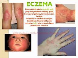 We did not find results for: Healthy Lovers Vitamin Shaklee Untuk Masalah Eczema Facebook