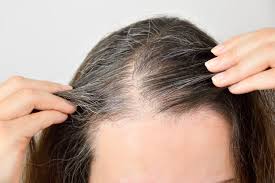 Cara atasi rambut uban gatal. Malas Warnai Rambut Bisa Pakai Cara Alami Ini Untuk Atasi Rambut Beruban Semua Halaman Nova