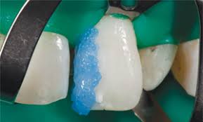 Maybe you would like to learn more about one of these? Esthetic Rehabilitation Of Anterior Teeth With Porcelain Laminates And Sectional Veneers Jcda