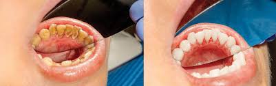Showed that using a salt water rinse can be very beneficial in healing gums inflamed by gingivitis. Gingivitis Periodontitis Effective Gum Disease Treatment