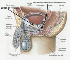 Image result for Radical Prostatectomy