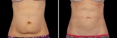 Maybe you would like to learn more about one of these? Coolsculpting Before And After Images Real Patient Results