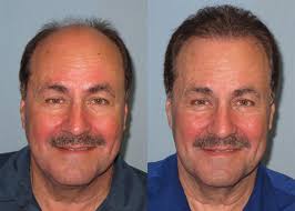American Board of Hair Restoration Surgery
