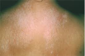 Morphea is a type of scleroderma that manifests in waxy patches of skin of varying size that can enlarge or shrink, or even disappear. Scleroderma Signs And Symptoms