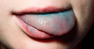 اللسان الأزرق وبعض الألوان الأخرى ويب طب