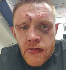 Irish boxer Graham McCormack has shared a photo of his injuries after  suffering a broken jaw in a bout. The Limerick man also suffered a bad cut  above his right eye from