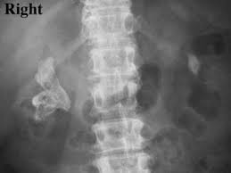 Large stones are in the ureter 4. Struvite And Staghorn Calculi Practice Essentials History Of The Procedure Problem