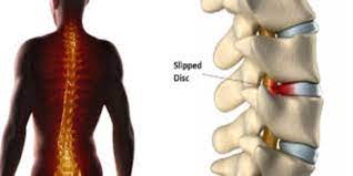 Kativasti is an ayurvedic treatment for slip disc, where medicated oils are used on your back to treat the herniated. Slipped Disc Causes Symptoms And Treatment Tribeca Care