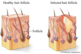 folliculitis my hair doctor