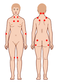 Die fibromyalgie ist die häufigste weichteilrheumatische erkrankung. Fibromyalgie Wikipedia