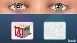 Image result for Amblyopia