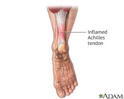 Here's a video from our musculoskeletal ultrasound tutorial series, made in partnership with canon medial systems. Achilles Tendon Anatomy Anatomy Drawing Diagram