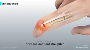 Start studying mallet baseball finger. Mallet Finger Video Medical Video Library