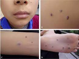 Blue Rubber Bleb Nevus Syndrome Manifest As Chronic Anemia In A 17 Year Old Boy