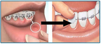 With the help of your forefinger and thumb, gently press the ball of wax on the brace causing the irritation. How To Use Orthodontic Wax News Dentagama