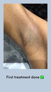 Approximately 20% of hair is treated with each treatment. I Went For My First Laser Hair Removal Treatment And This Is How Painful It Was The Laser Beautique