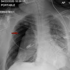 Image result for Pneumothorax