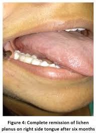 Image result for lichen planus on tongue)