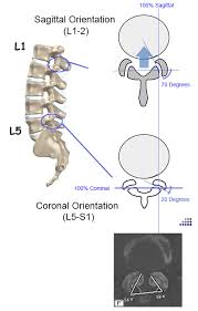 Capsules of lumbar zygoapophyseal joints. Lumbar Spine Anatomy Spine Orthobullets