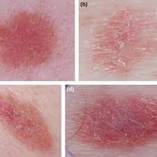 Pin On Melanoma