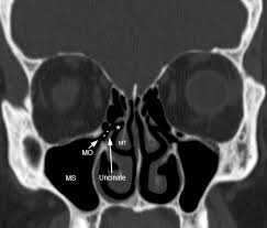 Image result for Maxillary Sinus