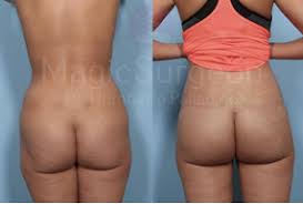 Buttock lift procedures are suitable for people who have considerable excess skin and sagging. How To Lift A Saggy Butt Magicsurgeon Dr Humberto Palladino