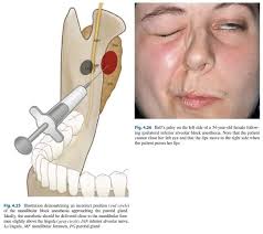 Bell's Palsy Dentistry Be careful while Infusing Inferior Alveolar Nerve  Block #LearningTips