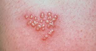 Hey loves, so cycle day 8 has arrived and i traveled back down to walter reed to get my hsg test done. Herpes Simplex Vienna Va Dermatologist