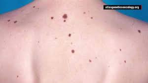 This type of cancer forms in the cells that give color to your skin, called melanocytes. Cancer States With The Highest Risk For Melanoma Linked To Uv Rays Cnn