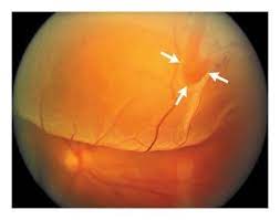 Retinal detachment is a condition in which the neurosensory retina is separated from the retinal pig­ment epithelium. Primary Retinal Detachment Nejm