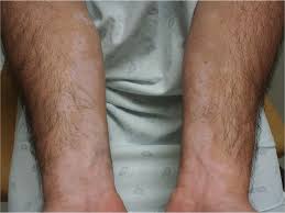 Image result for Diffuse Hyperpigmentation