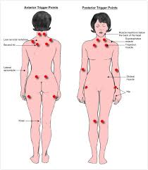 fibromyalgia syndrome or fs fms and its symptoms