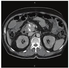 Contrast Enhanced Abdominal Computed Tomography Displaying A 1 Cm Download Scientific Diagram