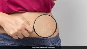 Can sweating get rid of cellulite? How To Remove Stretch Marks 7 Effective Natural Remedies Ndtv Food