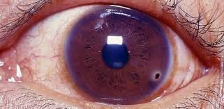 Image result for Eye Foreign Body