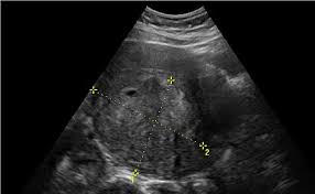 Image result for Leiomyosarcoma