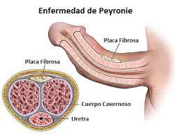 El centro de referencia para el diagnóstico y tratamiento integral de las enfermedades del varón. Enfermedad De Peyronie El Medico Contesta