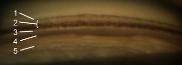 Image result for Gonioscopy